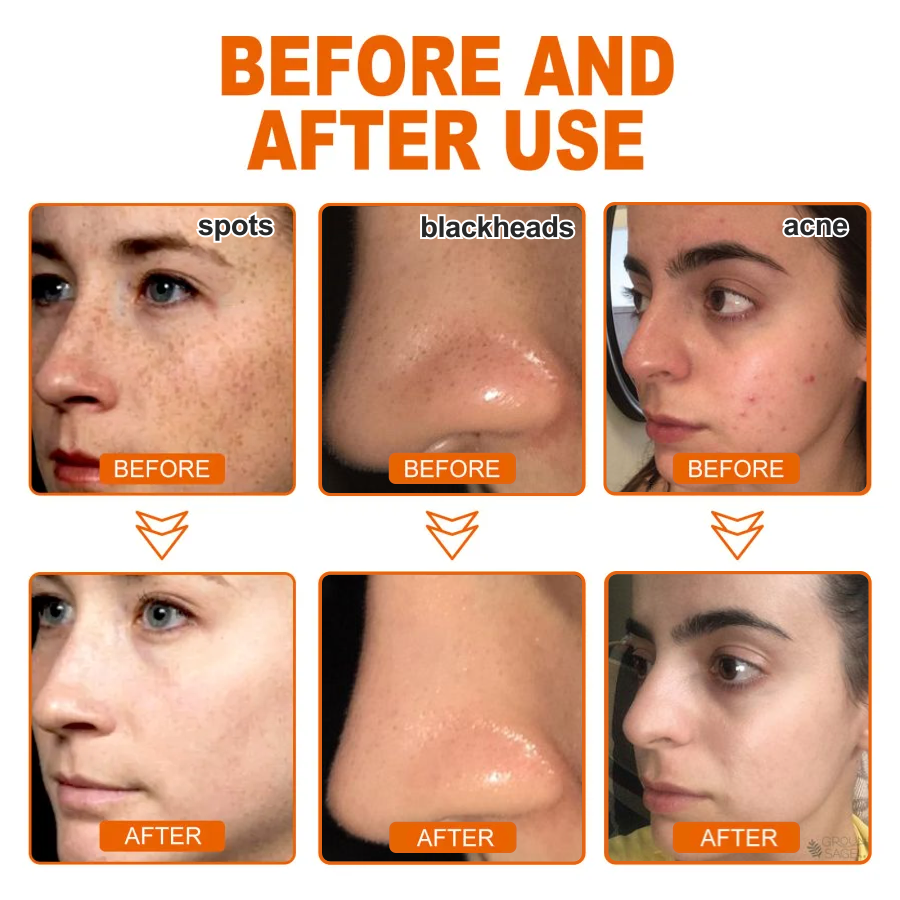 ✨Compra 2 y llévate 2 gratis✨Mascarilla exfoliante antiacné a base de hierbas