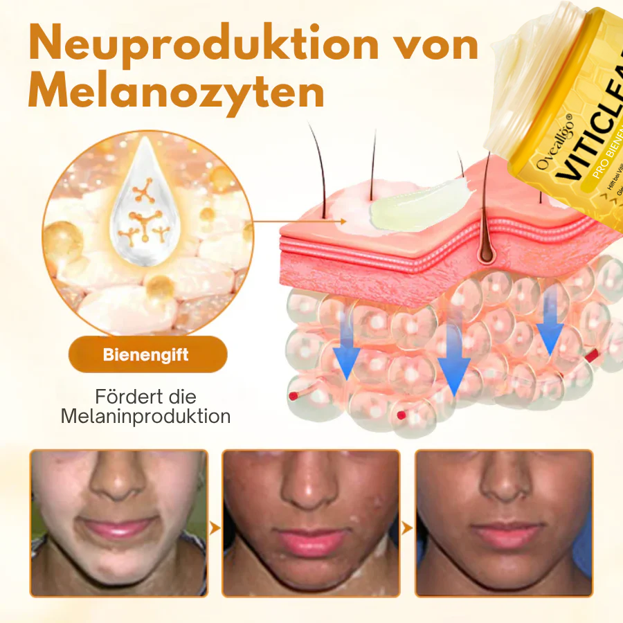 Ovealdgo® Viticlear Pro Skin Care Cream - 90% de soulagement efficace pour le vitiligo