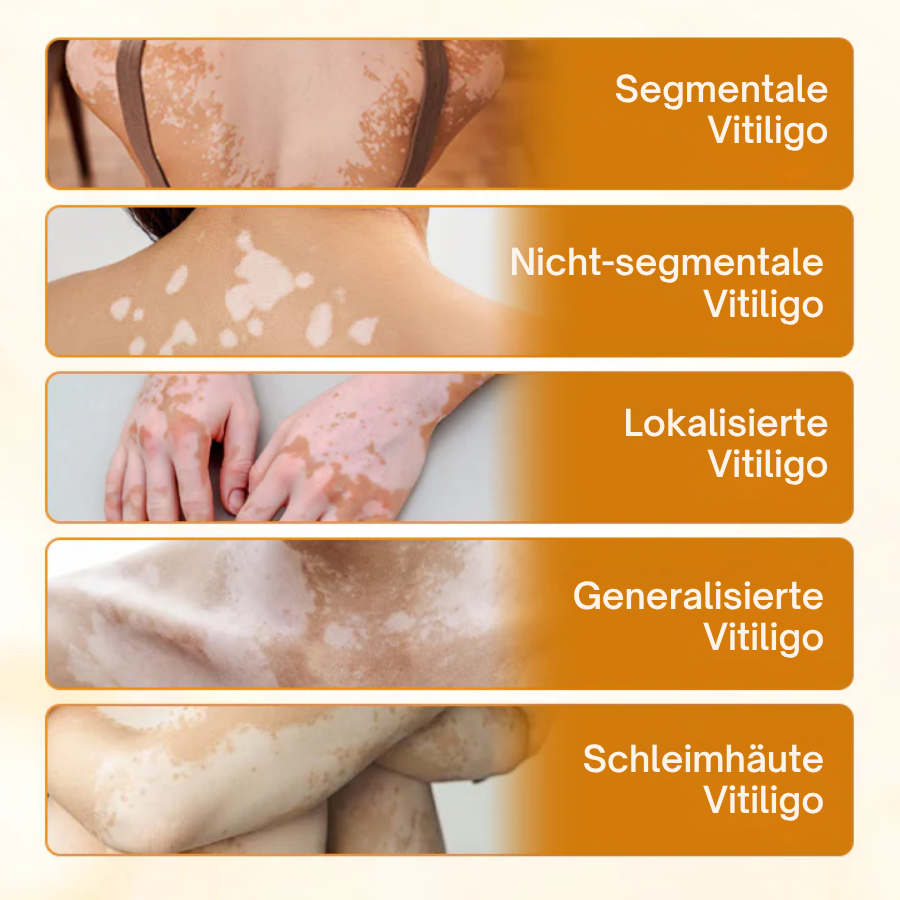 Ovealdgo® Viticlear Pro Skin Care Cream - 90% de soulagement efficace pour le vitiligo