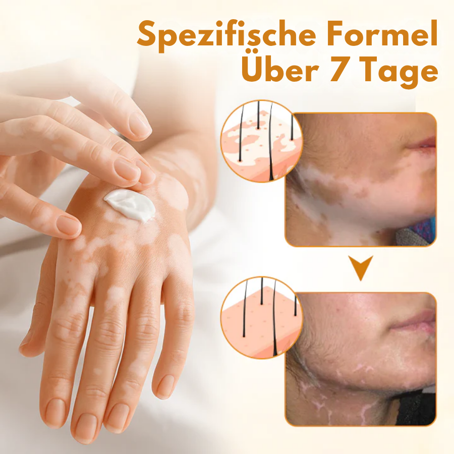 Crème au venin d'abeille Fivfivgo® VitiCalm,✔️95 % d'amélioration visible en 4 semaines, favorise la pigmentation et restaure le teint naturel de la peau