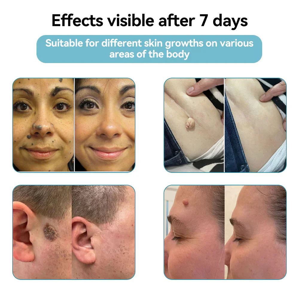 🇨🇦Stylo effaceur laser tout-en-un Bikenda® VelvetSkin+ (alimenté par la technologie laser CO₂ – élimine efficacement les grains de beauté, les verrues, les acrochordons, les taches pigmentaires et autres imperfections cutanées)