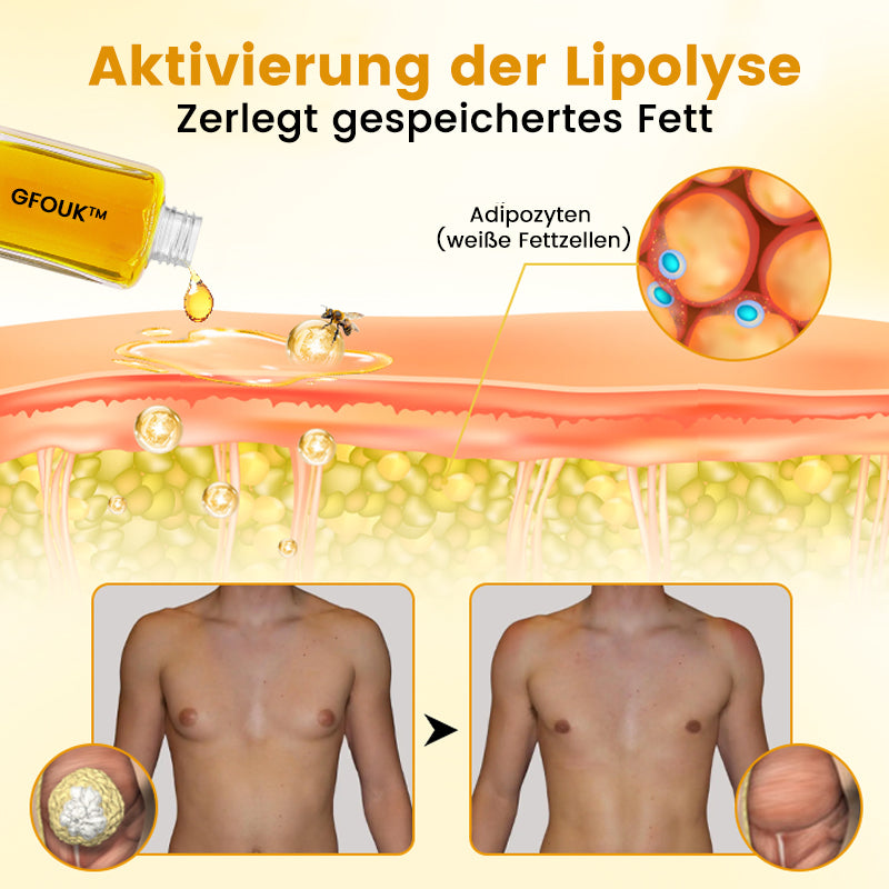 🔥Aceite de veneno de abeja GFOUK™ ThermoFirm para el tratamiento de la ginecomastia