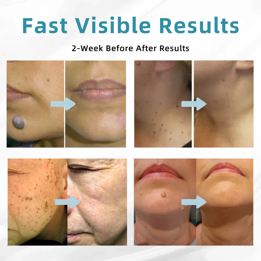 🇨🇦Stylo effaceur laser tout-en-un Bikenda® VelvetSkin+ (alimenté par la technologie laser CO₂ – élimine efficacement les grains de beauté, les verrues, les acrochordons, les taches pigmentaires et autres imperfections cutanées)