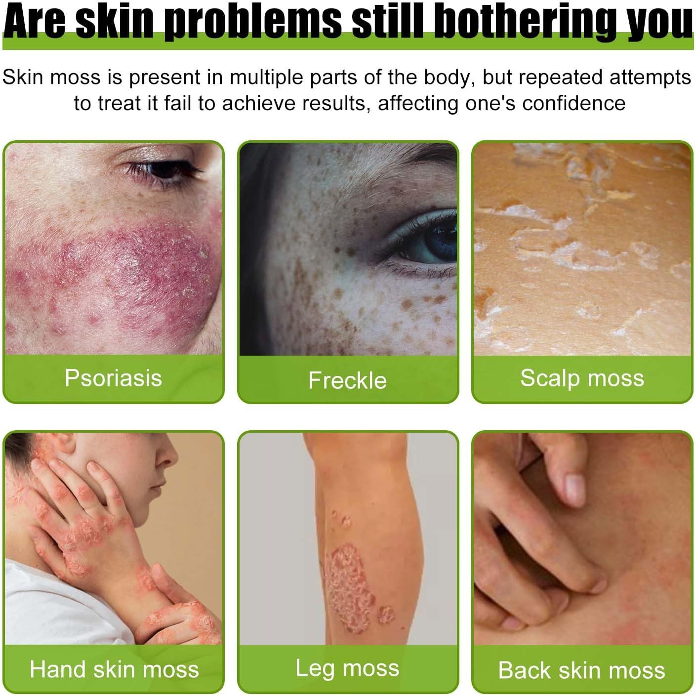 Todahof bienengift-psoriasis behandelingscrème, todahof bienengift-psoriasis behandeling crème, todahof bienengift-cream, psoriasis crème, beeergift psoriasis behandeling crème (3 stuks)