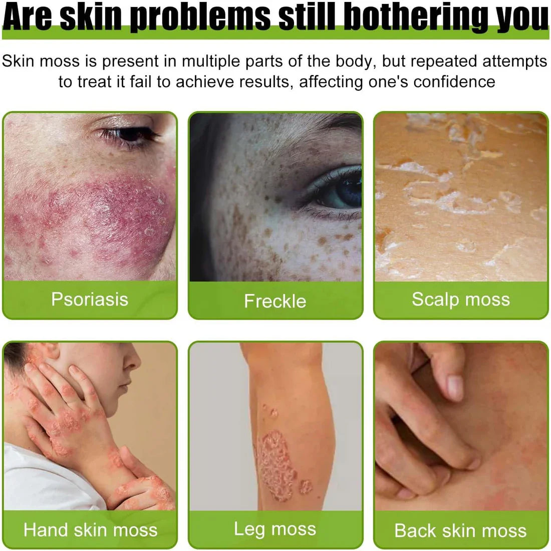 Todahof Biegenfift Psoriasis Treatment Crem, Todahof Biegenfift Psoriasis Treat Cream, Todahof Bienengift Cream, Psoriasis Cream, Beeergift Psoriasis Treatment Cream (3 pièces)