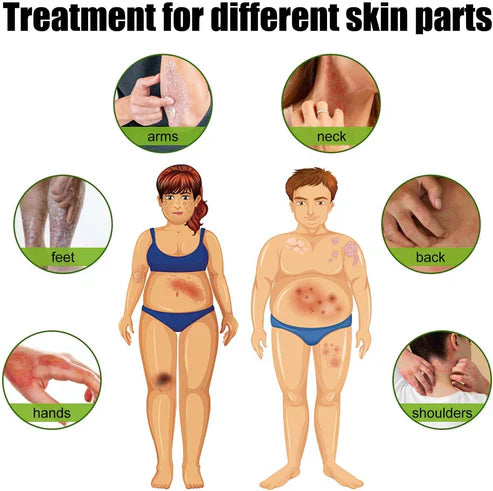 Todahof Biegenfift Psoriasis Treatment Crem, Todahof Biegenfift Psoriasis Treat Cream, Todahof Bienengift Cream, Psoriasis Cream, Beeergift Psoriasis Treatment Cream (3 pièces)