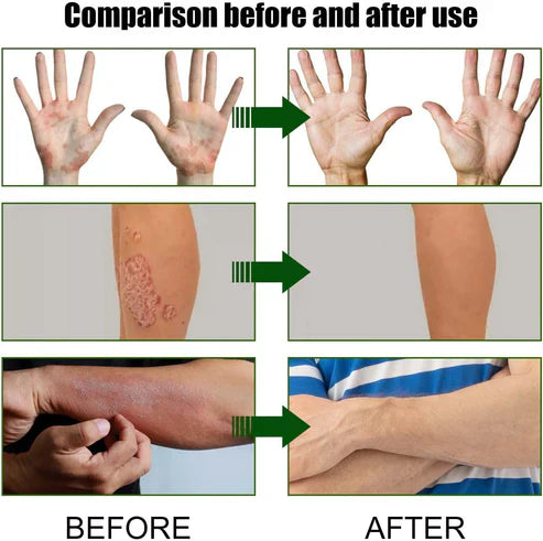 Todahof Biegenfift Psoriasis Treatment Crem, Todahof Biegenfift Psoriasis Treat Cream, Todahof Bienengift Cream, Psoriasis Cream, Beeergift Psoriasis Treatment Cream (3 pièces)