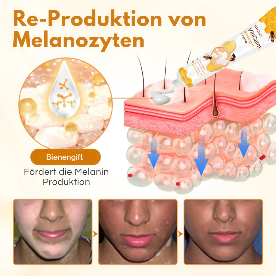 Crème au venin d'abeille Fivfivgo® VitiCalm,✔️95 % d'amélioration visible en 4 semaines, favorise la pigmentation et restaure le teint naturel de la peau