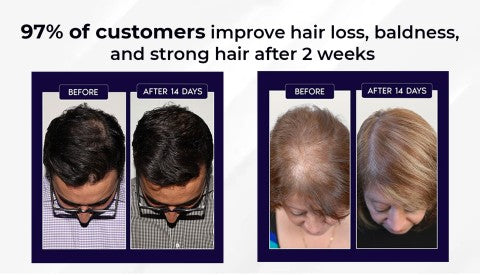 🌿PROMOCIÓN DE ÚLTIMO DÍA – 50% DE DESCUENTO🌿 Spray para el crecimiento natural del cabello HZA™