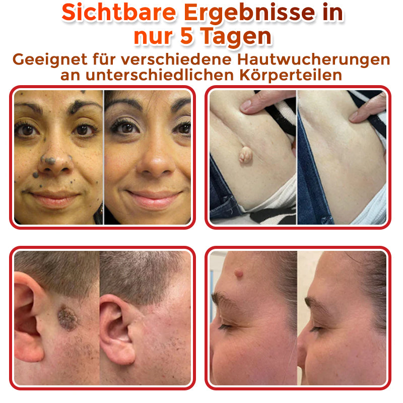 Patch botanique de micro-aiguilletage GFOUK® pour l'élimination des acrochordons 🇩🇪 Fabriqué en Allemagne