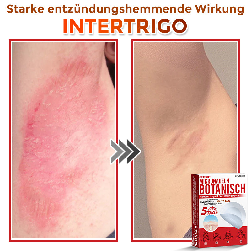 Patch botanique de micro-aiguilletage GFOUK® pour l'élimination des acrochordons 🇩🇪 Fabriqué en Allemagne
