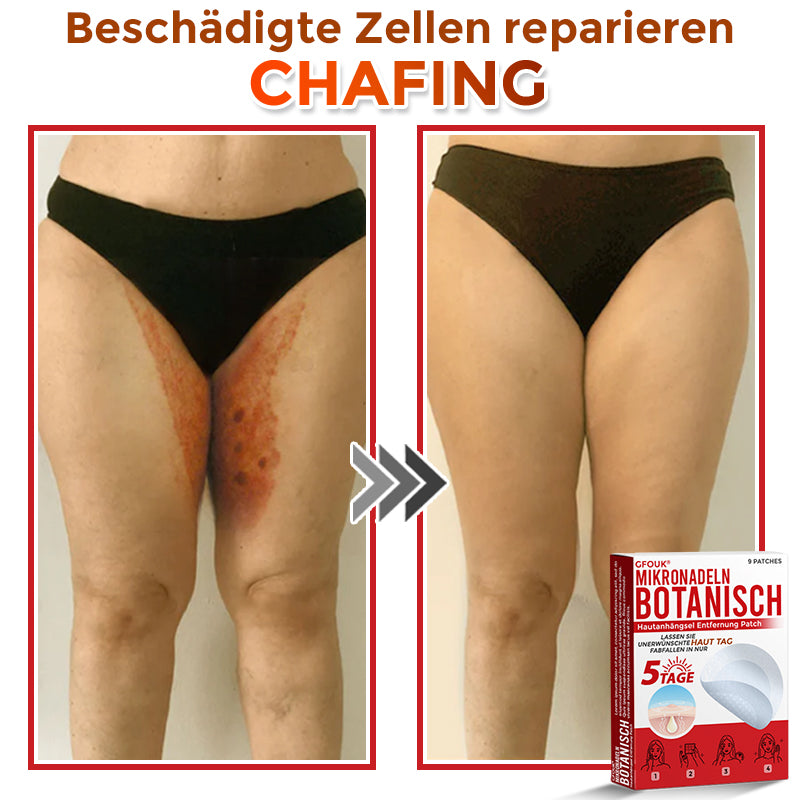 Patch botanique de micro-aiguilletage GFOUK® pour l'élimination des acrochordons 🇩🇪 Fabriqué en Allemagne