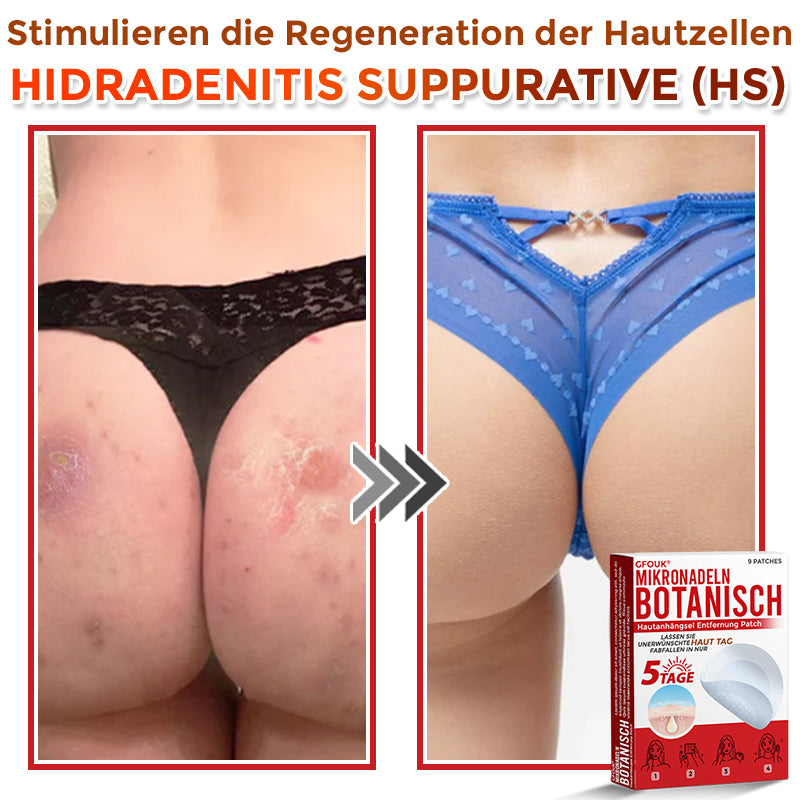 Patch botanique de micro-aiguilletage GFOUK® pour l'élimination des acrochordons 🇩🇪 Fabriqué en Allemagne
