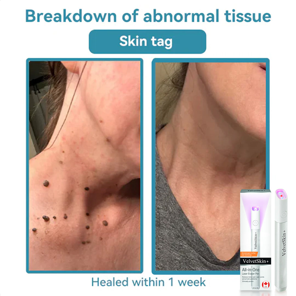 🇨🇦Stylo effaceur laser tout-en-un Bikenda® VelvetSkin+ (alimenté par la technologie laser CO₂ – élimine efficacement les grains de beauté, les verrues, les acrochordons, les taches pigmentaires et autres imperfections cutanées)