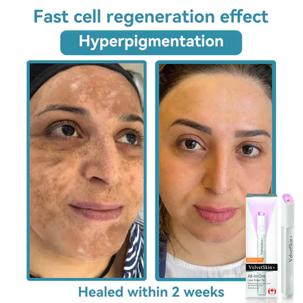 🇨🇦Stylo effaceur laser tout-en-un Bikenda® VelvetSkin+ (alimenté par la technologie laser CO₂ – élimine efficacement les grains de beauté, les verrues, les acrochordons, les taches pigmentaires et autres imperfections cutanées)