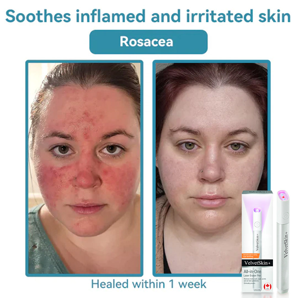 🇨🇦Stylo effaceur laser tout-en-un Bikenda® VelvetSkin+ (alimenté par la technologie laser CO₂ – élimine efficacement les grains de beauté, les verrues, les acrochordons, les taches pigmentaires et autres imperfections cutanées)