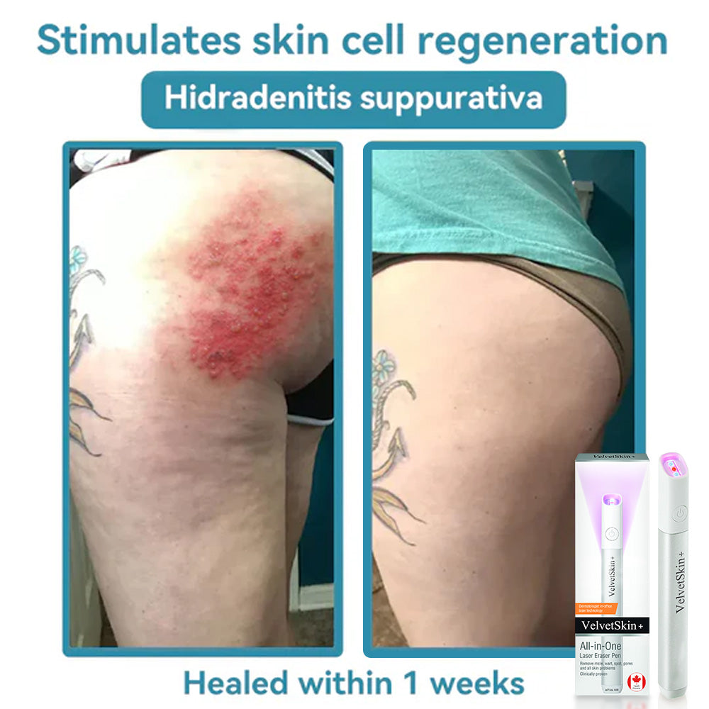 🇨🇦Stylo effaceur laser tout-en-un Bikenda® VelvetSkin+ (alimenté par la technologie laser CO₂ – élimine efficacement les grains de beauté, les verrues, les acrochordons, les taches pigmentaires et autres imperfections cutanées)