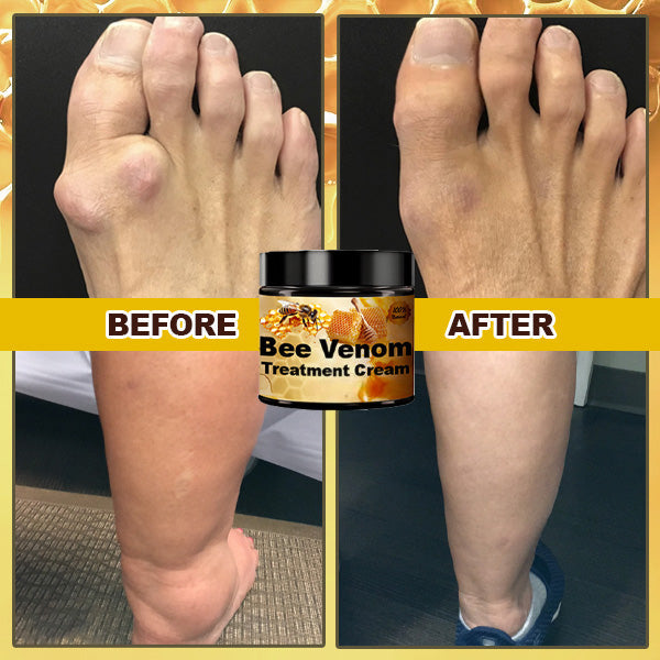 Crème de beeengift pour le traitement de l'arthrite