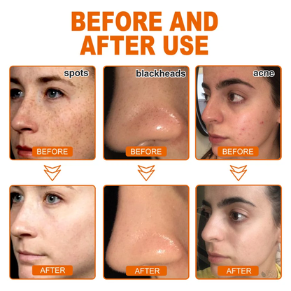 ✨Compra 2 y llévate 2 gratis✨Mascarilla exfoliante antiacné a base de hierbas