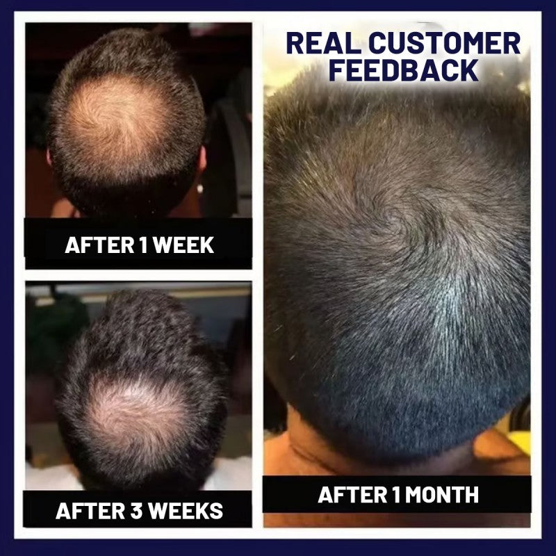 🌿PROMOCIÓN DE ÚLTIMO DÍA – 50% DE DESCUENTO🌿 Spray para el crecimiento natural del cabello HZA™