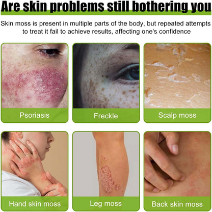 Todahof bienengift-psoriasis behandelingscrème, todahof bienengift-psoriasis behandeling crème, todahof bienengift-cream, psoriasis crème, beeergift psoriasis behandeling crème (3 stuks)