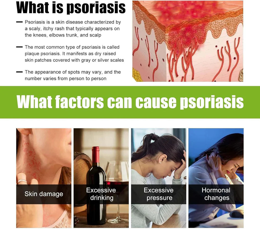 Todahof Biegenfift Psoriasis Treatment Crem, Todahof Biegenfift Psoriasis Treat Cream, Todahof Bienengift Cream, Psoriasis Cream, Beeergift Psoriasis Treatment Cream (3 pièces)