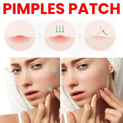 Pavimentazione dei brufoli di ostriche per il viso, pavimentazione dell'acne idrocolloide