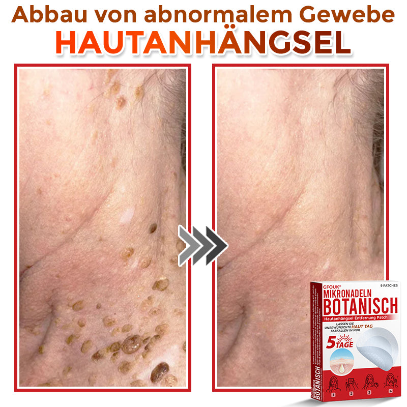 Patch botanique de micro-aiguilletage GFOUK® pour l'élimination des acrochordons 🇩🇪 Fabriqué en Allemagne