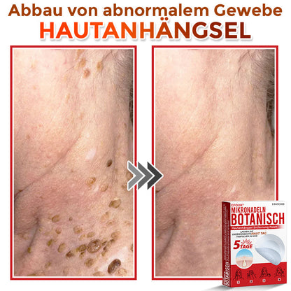 Patch botanique de micro-aiguilletage GFOUK® pour l'élimination des acrochordons 🇩🇪 Fabriqué en Allemagne