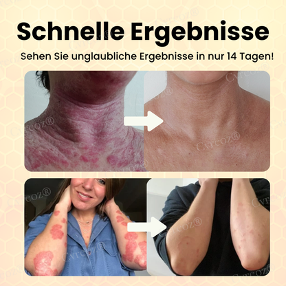 CVREOZ® BEENENGIFT PSORIASIS TRAITEM