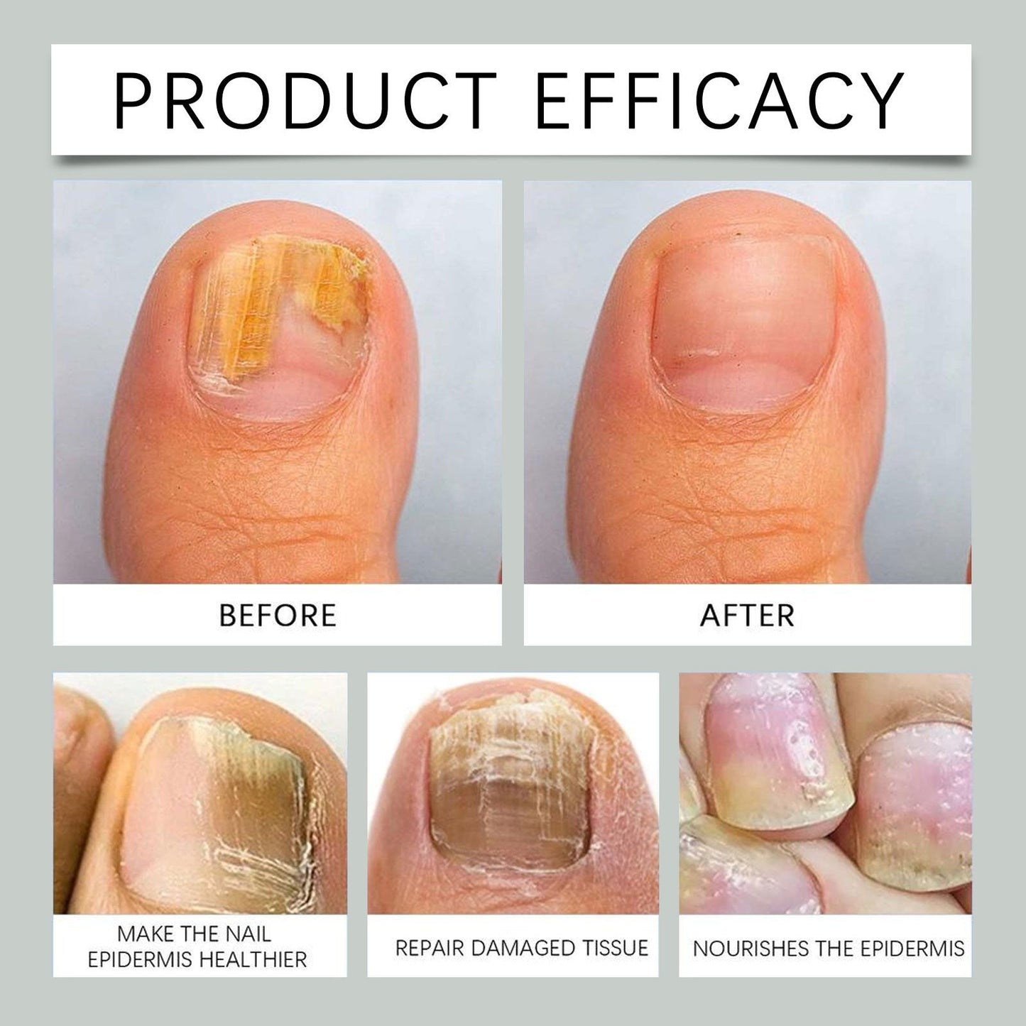 Furzero™ - LUNE DU SUD🌟 Traitement des mycoses des ongles au venin d'abeille : une solution complète contre les mycoses des ongles