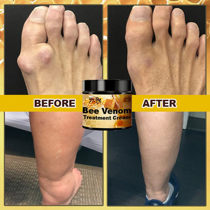 Crème de beeengift pour le traitement de l'arthrite